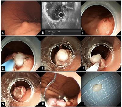 Safety and efficacy of a modified endoscopic full-thickness resection technique for gastric submucosal tumors: a case series